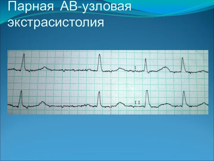 Парная АВ-узловая экстрасистолия