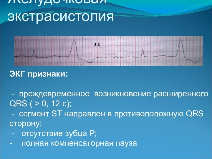 Желудочковая экстрасистолия . ЭКГ признаки: - преждевременное возникновение расширенного QRS (