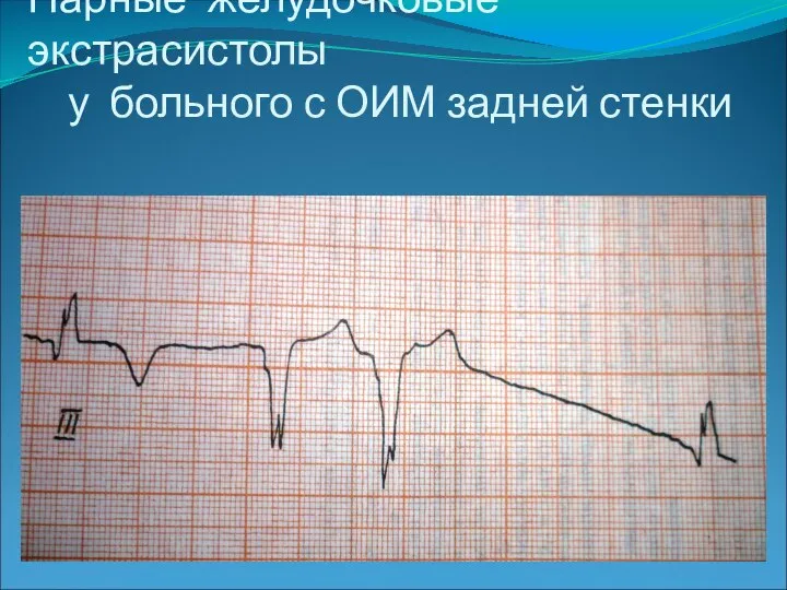 Парные желудочковые экстрасистолы у больного с ОИМ задней стенки