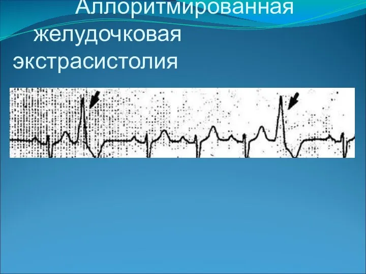 Аллоритмированная желудочковая экстрасистолия