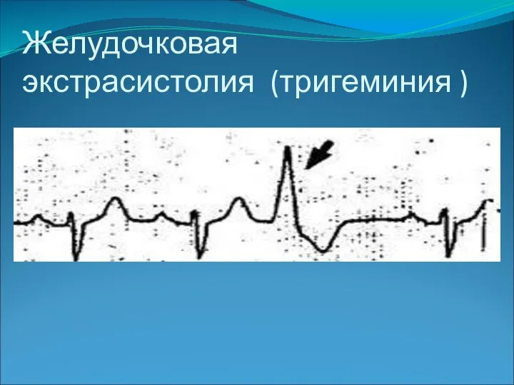 Желудочковая экстрасистолия (тригеминия )