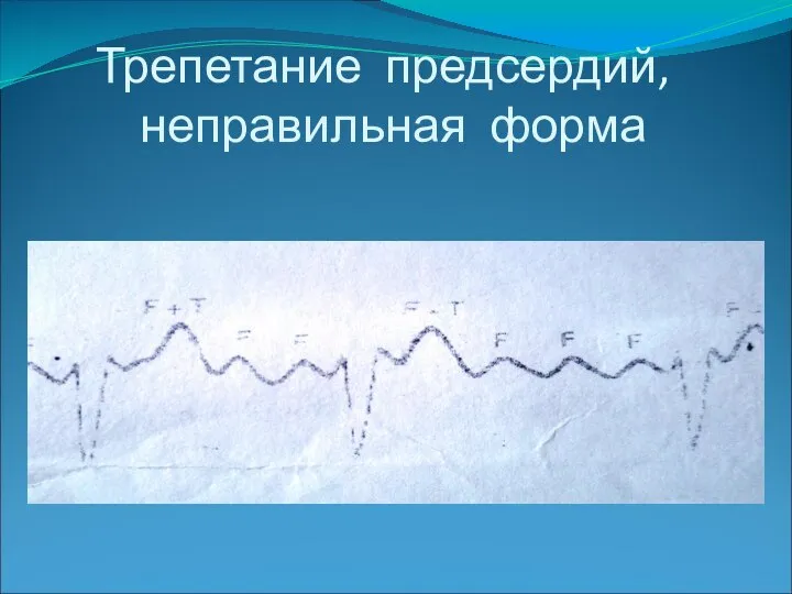 Трепетание предсердий, неправильная форма