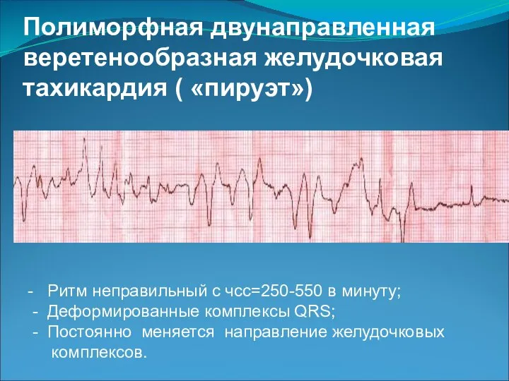 Полиморфная двунаправленная веретенообразная желудочковая тахикардия ( «пируэт») - Ритм неправильный с