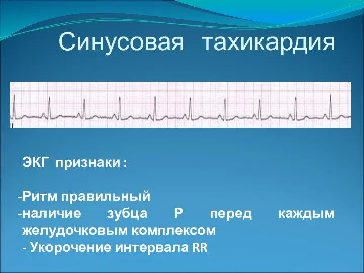 Синусовая тахикардия ЭКГ признаки : Ритм правильный наличие зубца Р перед