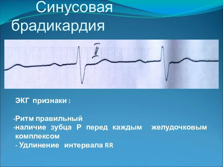 Синусовая брадикардия ЭКГ признаки : Ритм правильный наличие зубца Р перед