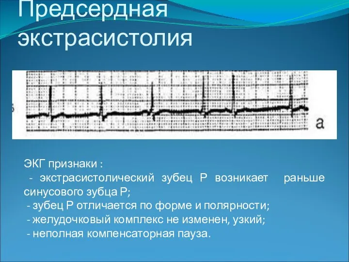 Предсердная экстрасистолия ЭКГ признаки : - экстрасистолический зубец Р возникает раньше