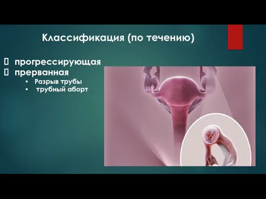 Классификация (по течению) прогрессирующая прерванная Разрыв трубы трубный аборт