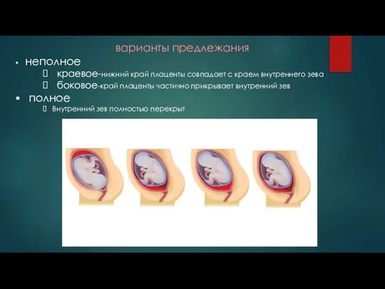 варианты предлежания неполное краевое-нижний край плаценты совпадает с краем внутреннего зева