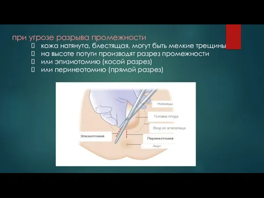 при угрозе разрыва промежности кожа натянута, блестящая, могут быть мелкие трещины