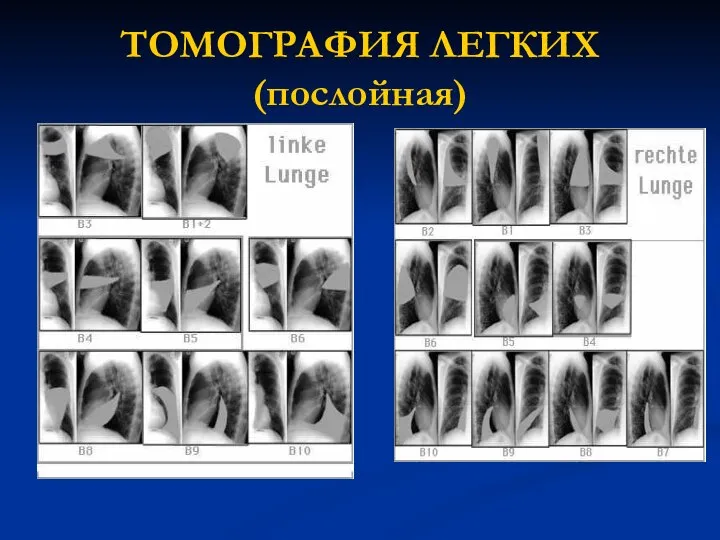 ТОМОГРАФИЯ ЛЕГКИХ (послойная)