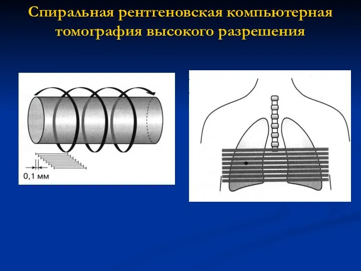 Спиральная рентгеновская компьютерная томография высокого разрешения