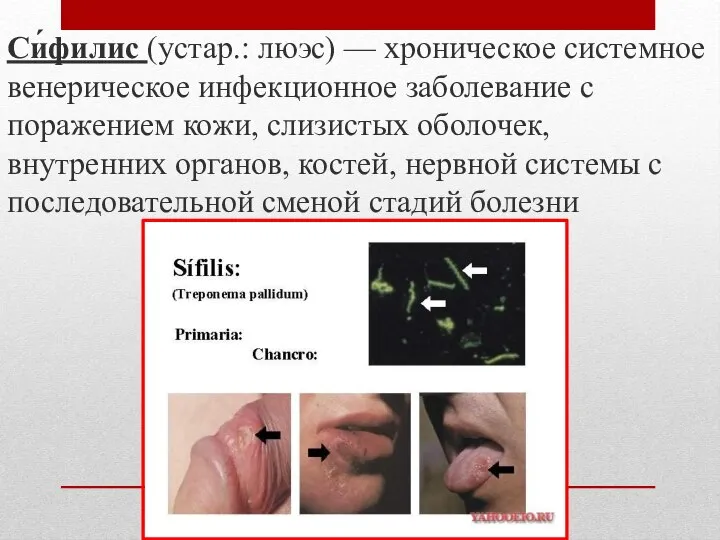 Си́филис (устар.: люэс) — хроническое системное венерическое инфекционное заболевание с поражением