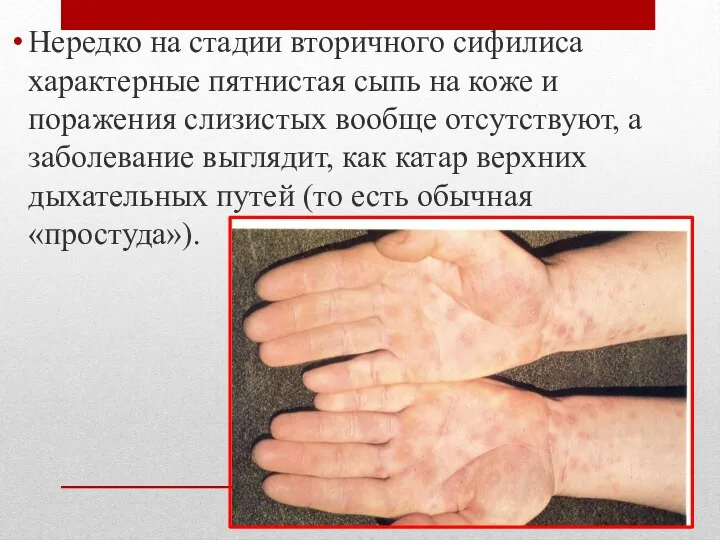 Нередко на стадии вторичного сифилиса характерные пятнистая сыпь на коже и