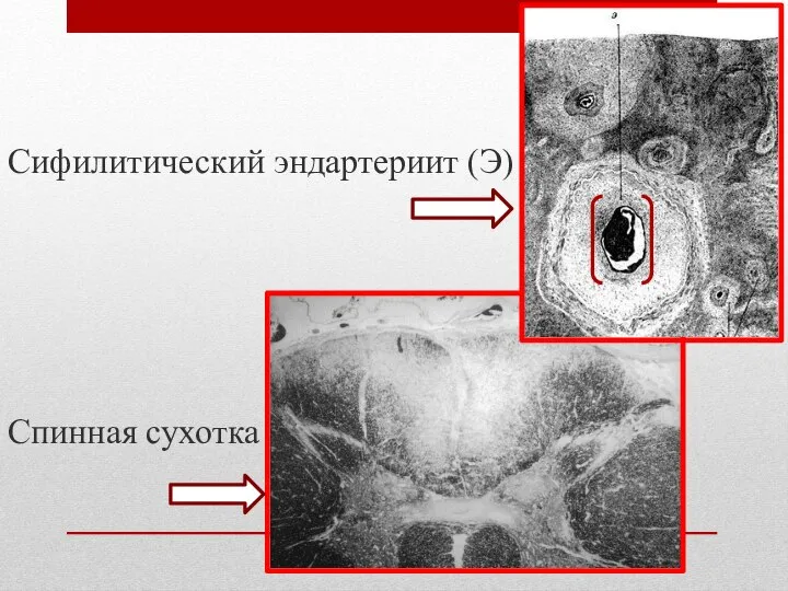 Сифилитический эндартериит (Э) Спинная сухотка