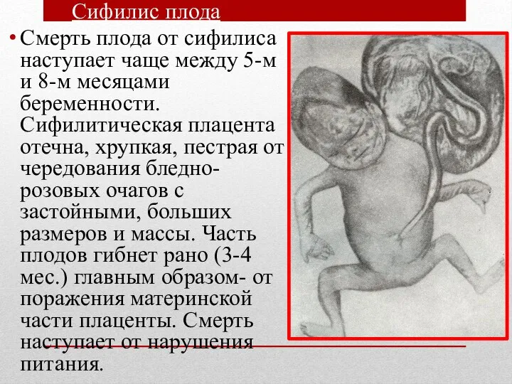 Сифилис плода Смерть плода от сифилиса наступает чаще между 5-м и