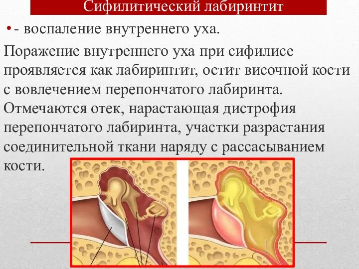 Сифилитический лабиринтит - воспаление внутреннего уха. Поражение внутреннего уха при сифилисе