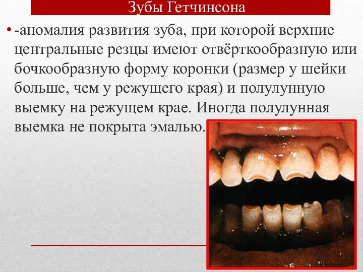 Зубы Гетчинсона -аномалия развития зуба, при которой верхние центральные резцы имеют