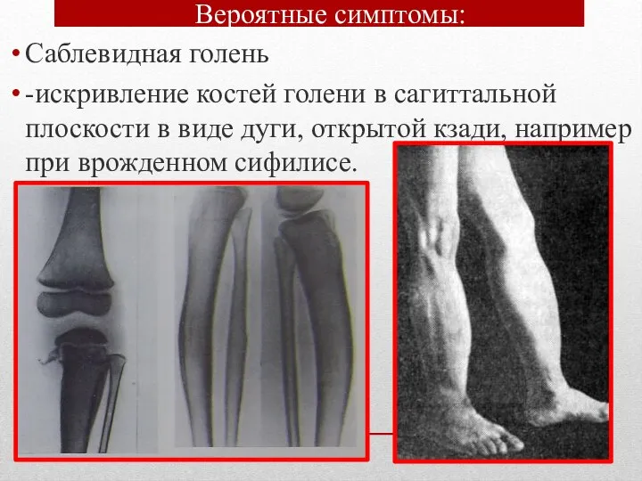 Вероятные симптомы: Саблевидная голень -искривление костей голени в сагиттальной плоскости в