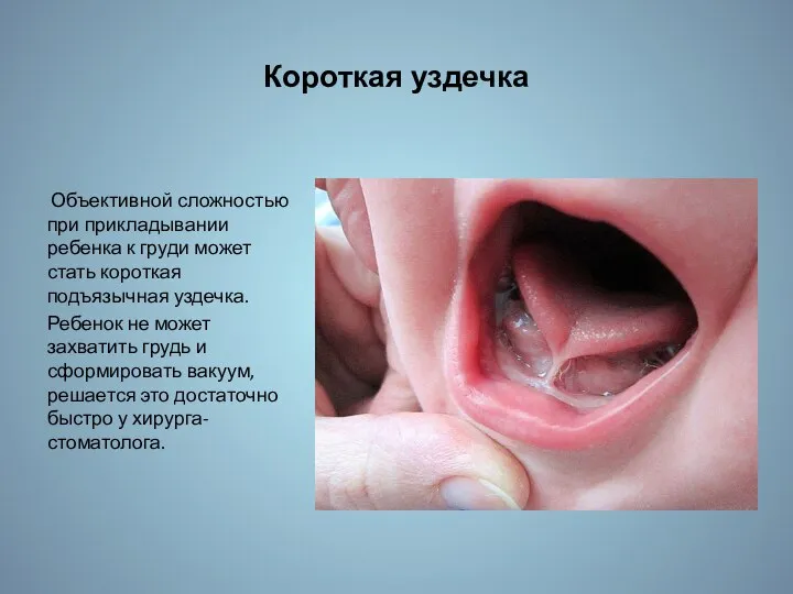 Короткая уздечка Объективной сложностью при прикладывании ребенка к груди может стать