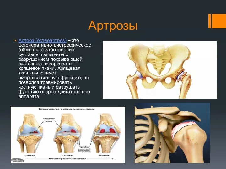 Артрозы Артроз (остеоартроз) – это дегенеративно-дистрофическое (обменное) заболевание суставов, связанное с