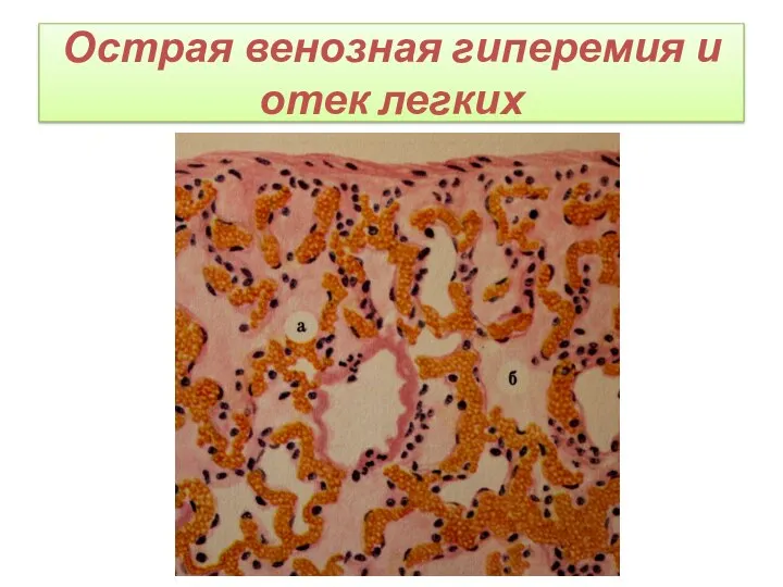 Острая венозная гиперемия и отек легких