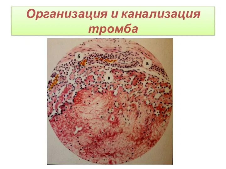 Организация и канализация тромба