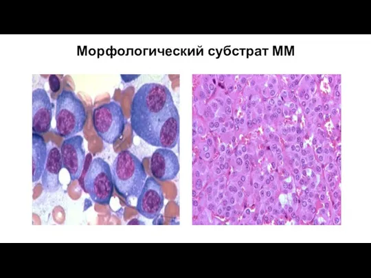 Морфологический субстрат ММ