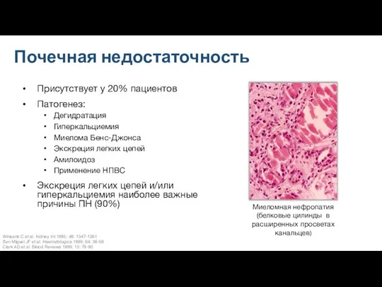 Почечная недостаточность Присутствует у 20% пациентов Патогенез: Дегидратация Гиперкальциемия Миелома Бенс-Джонса