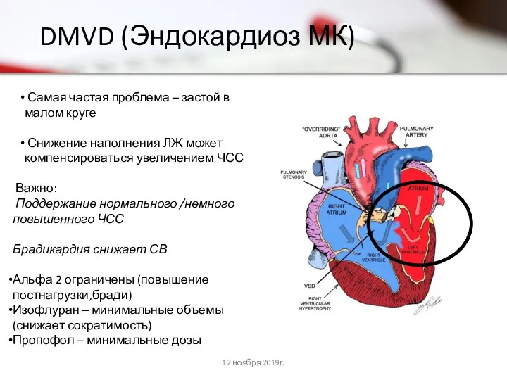 DMVD (Эндокардиоз МК) 12 ноября 2019г. Самая частая проблема – застой