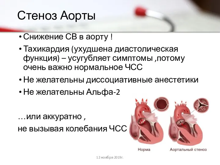 Стеноз Аорты Снижение СВ в аорту ! Тахикардия (ухудшена диастолическая функция)