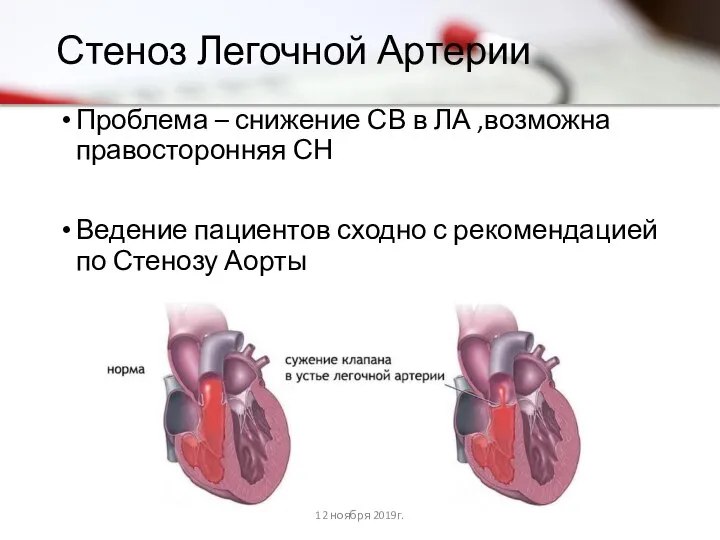 Стеноз Легочной Артерии Проблема – снижение СВ в ЛА ,возможна правосторонняя