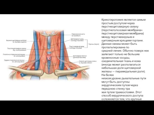 Крикотирогомия является самым простым досту­пом через перстнещитовидную связку (перстнеголо­совая мембрана» перстнещитовидная
