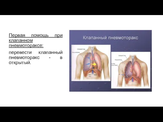 Первая помощь при клапанном пневмотораксе: перевести клапанный пневмоторакс - в открытый.