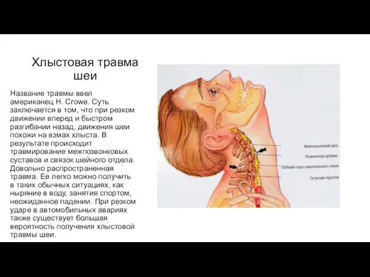 Хлыстовая травма шеи Название травмы ввел американец Н. Сrowe. Суть заключается