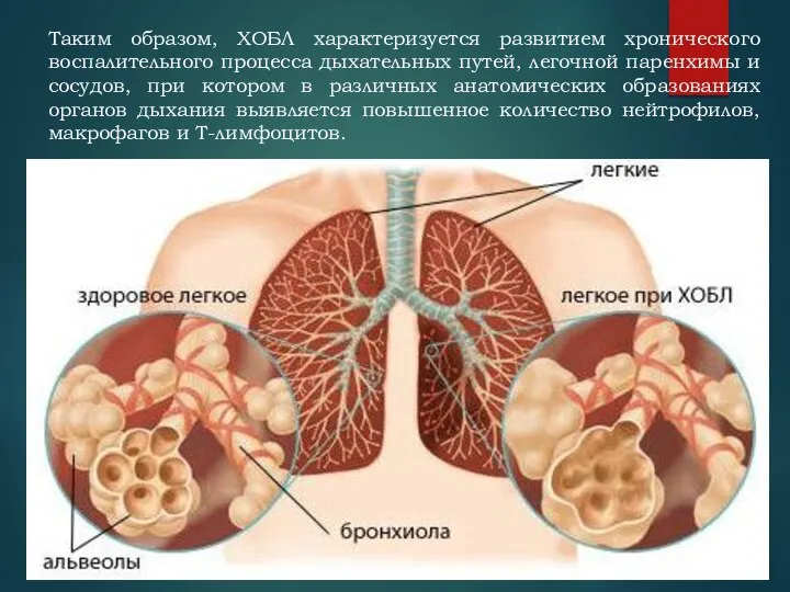 Таким образом, ХОБЛ характеризуется развитием хронического воспалительного процесса дыхательных путей, легочной