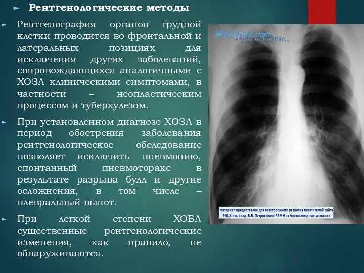 Рентгенологические методы Рентгенография органов грудной клетки проводится во фронтальной и латеральных