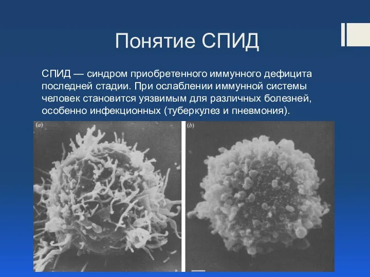 Понятие СПИД СПИД — синдром приобретенного иммунного дефицита последней стадии. При