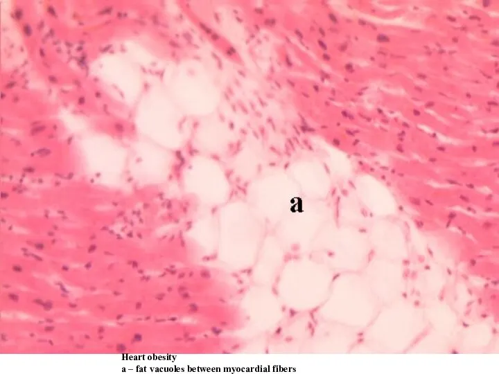 Heart obesity а – fat vacuoles between myocardial fibers