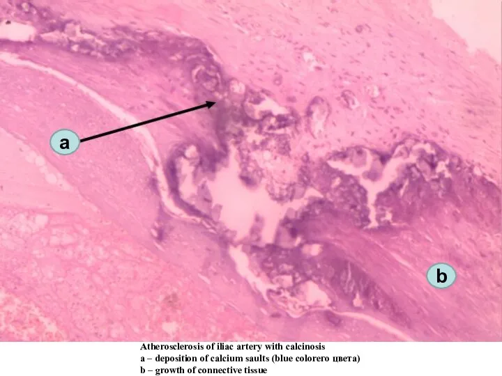 Atherosclerosis of iliac artery with calcinosis а – deposition of calcium