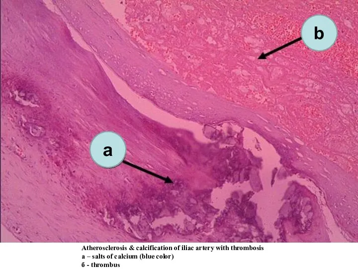 Atherosclerosis & calcification of iliac artery with thrombosis а – salts