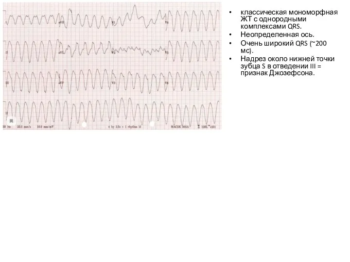 классическая мономорфная ЖТ с однородными комплексами QRS. Неопределенная ось. Очень широкий