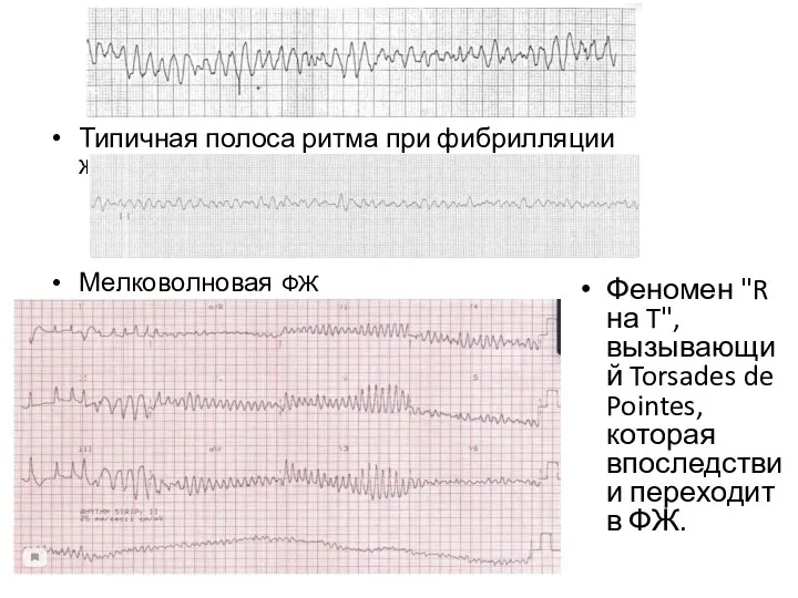 Типичная полоса ритма при фибрилляции желудочков Мелковолновая ФЖ Феномен "R на