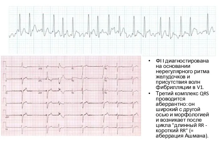 ФП диагностирована на основании нерегулярного ритма желудочков и присутствия волн фибрилляции