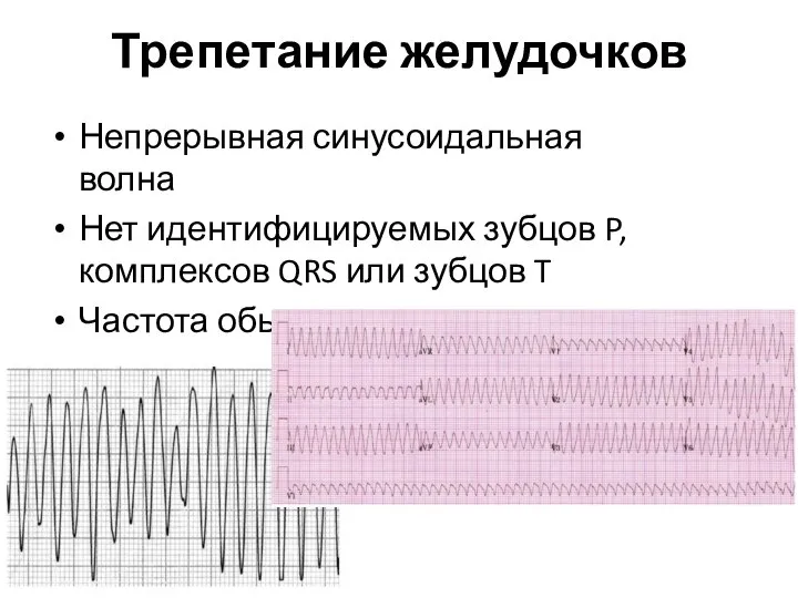 Трепетание желудочков Непрерывная синусоидальная волна Нет идентифицируемых зубцов P, комплексов QRS