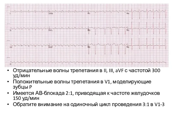 Отрицательные волны трепетания в II, III, aVF с частотой 300 уд/мин