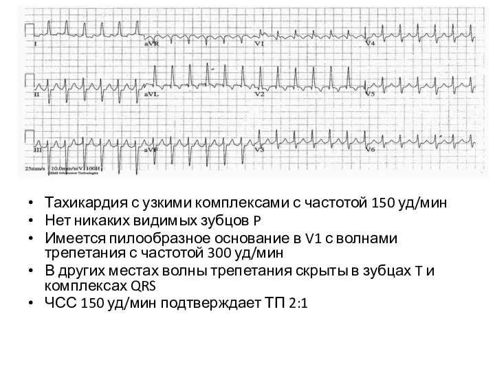 Тахикардия с узкими комплексами с частотой 150 уд/мин Нет никаких видимых