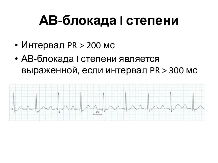 АВ-блокада I степени Интервал PR > 200 мс АВ-блокада I степени