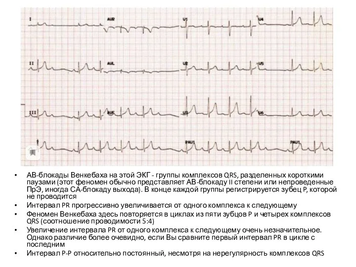 АВ-блокады Венкебаха на этой ЭКГ - группы комплексов QRS, разделенных короткими