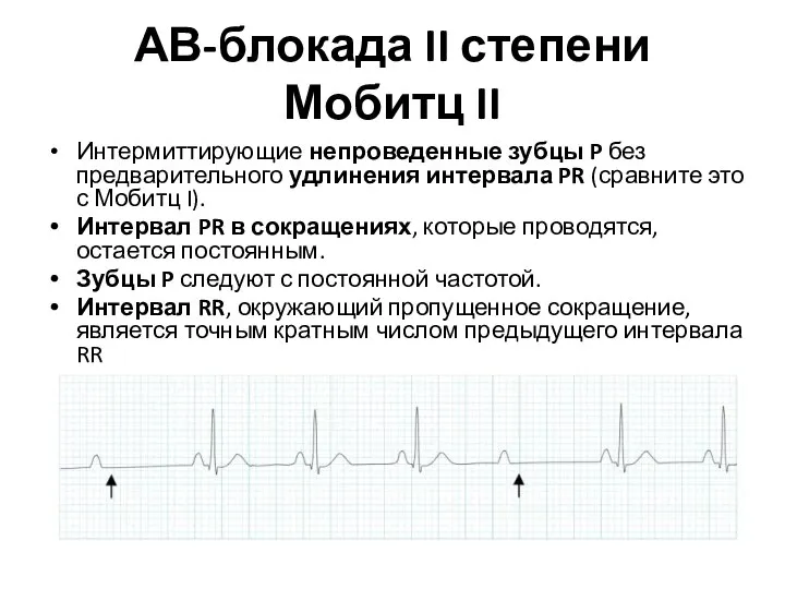 АВ-блокада II степени Мобитц II Интермиттирующие непроведенные зубцы P без предварительного