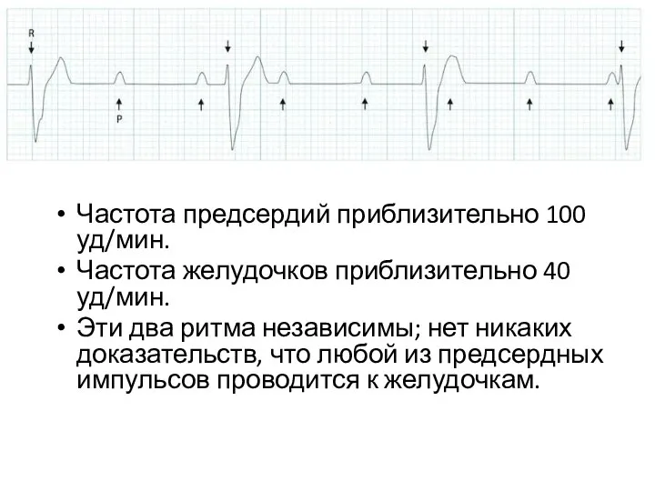 Частота предсердий приблизительно 100 уд/мин. Частота желудочков приблизительно 40 уд/мин. Эти